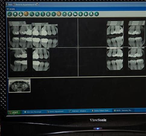 Fillings | Academy Dental Group